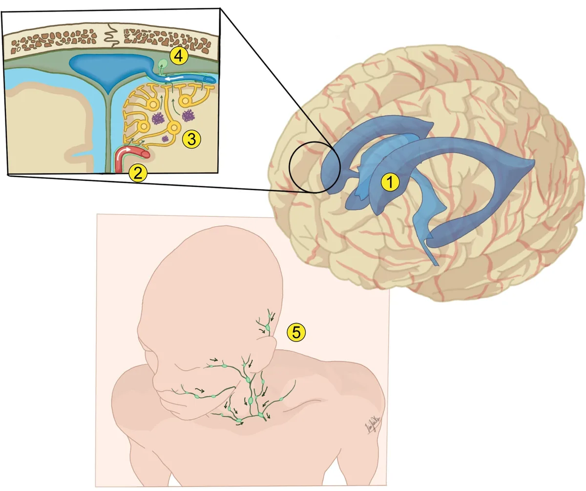 Lymphovenous Bypass: Promising Surgery for Alzheimer’s